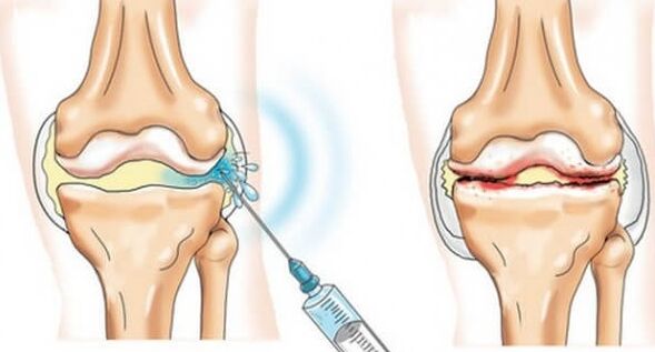 Medidas médicas para artrose